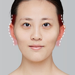 Assessing sunken cheekbones or temple area with a staircase effect following cheekbone surgery