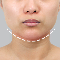 Assessing lack of visible effect after square jaw surgery and genioplasty during postoperative evaluation