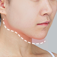 Assessing formation of a secondary angle or staircase effect after jaw contouring surgery