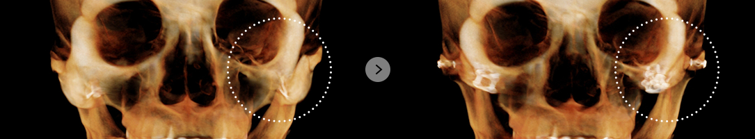 If there is no effect after cheekbone reduction surgery