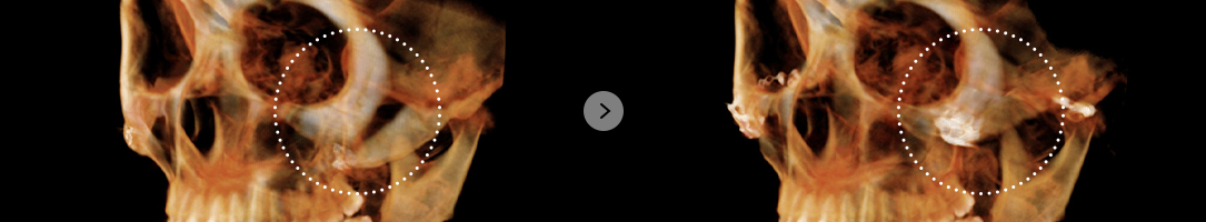 If the cheekbone is drooping and non-union after surgery