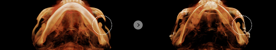 If the temple area is sunken or has a staircase effect after surgery