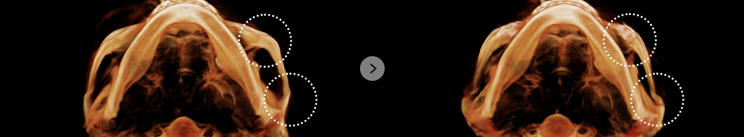 If there is asymmetry within the left and right sides of the face after surgery .