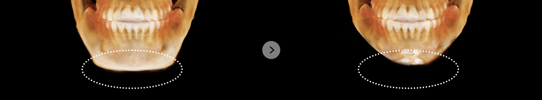 If there are no effects after square jaw reduction