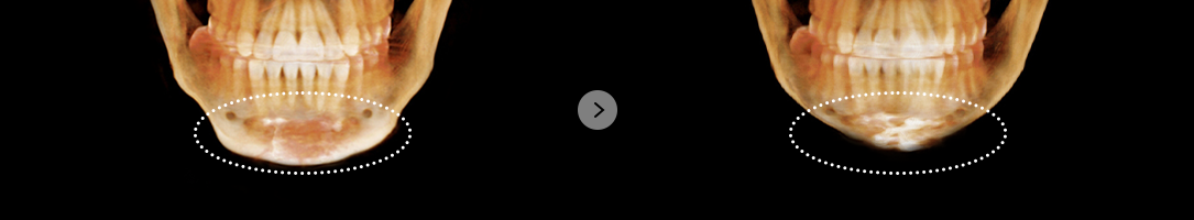 If there are no effects after square jaw surgery and genioplasty