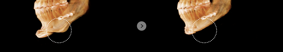 If there is a formation of secondary angle and staircase effect after surgery