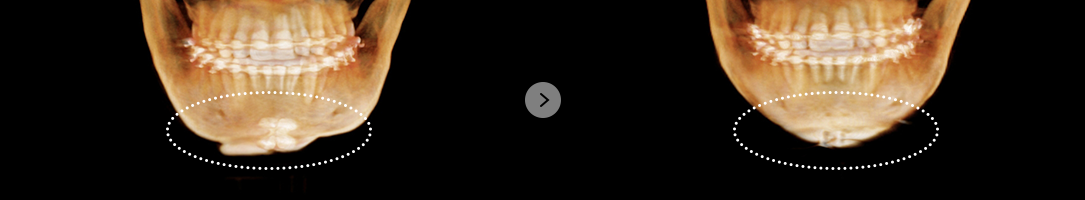 If the chin is too short after surgery