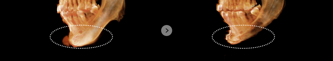 If the revision surgery is required because of complication after chin implant augmentation