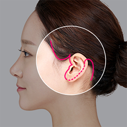 Comparing Mini SMAS facelift incision along the sideburn and behind the earlobe with Full SMAS facelift incision extending behind the ear into the posterior hairline