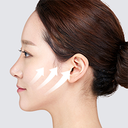 Simultaneously lifting the SMAS layer together with the skin during facelift surgery