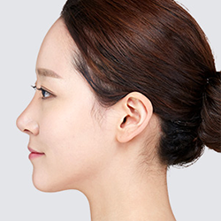 Excising sagging skin and SMAS layer and completing the procedure with double sutures during facelift surgery