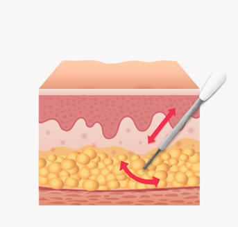 Dissolving targeted fat between the dermis and facial layer without damaging surrounding tissue during laser treatment