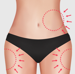 Harvesting fat from the inner or lateral thighs, or the abdomen when thigh fat is insufficient, for fat grafting