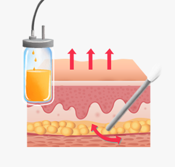 Performing micro adipocyte transplantation using three-dimensional multilayer injection technique