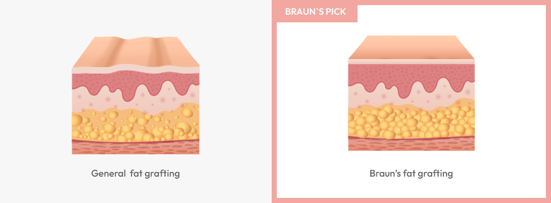 Braun's Fat Grafting Surgery