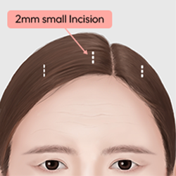 Making three to five small incisions inside the hairline to minimize visible scarring