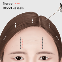 Using a full HD endoscope to confirm nerve and blood vessel positions before gently dissecting the sagging forehead