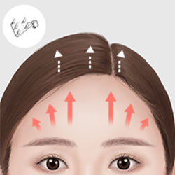 Placing and securing an endotine in the deep fascia or skull to lift the drooping forehead