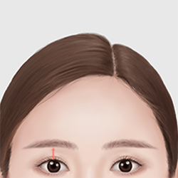 Improving wrinkles between the brows, around the eyes, and on the eyelids to achieve a resilient facial appearance