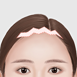 Designing the procedure based on forehead width, position, angle, and hairline shape