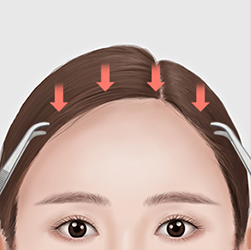 Dissecting the forehead and scalp while preserving nerves and blood vessels during surgery