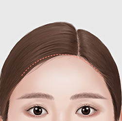 Pulling down the dissected scalp, removing excess skin, and securing it firmly during forehead surgery