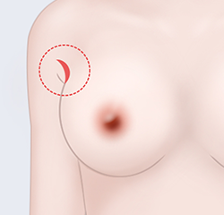 Transaxillary (Armpit incision)