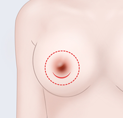 Periareolar (Areolar incision)