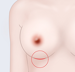 Inframammary (Incision below the breast)