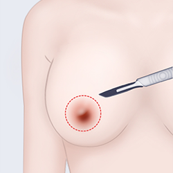 Removing the epidermal layer after making an incision around the areola during breast surgery