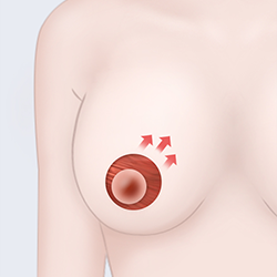 Repositioning the nipple to the desired height and removing sagging skin along the areola during breast surgery