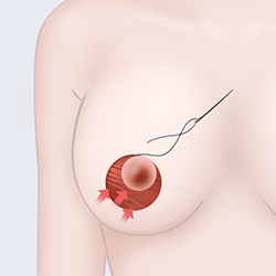 Excising sagging skin and mammary gland tissue during breast surgery