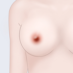 Suturing the areola to complete the procedure