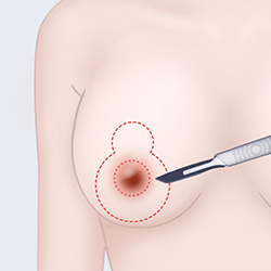 Removing the epidermal layer after making an incision around the areola during breast surgery