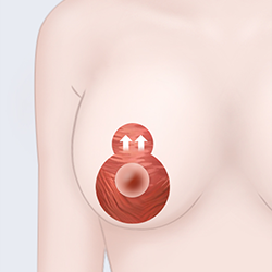 Removing sagging skin around the areola during breast surgery