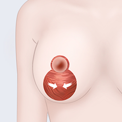 Correcting sagging mammary tissue and skin after excision and removal during breast surgery