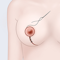 Suturing the surgical site while adjusting the size of the areola during breast surgery