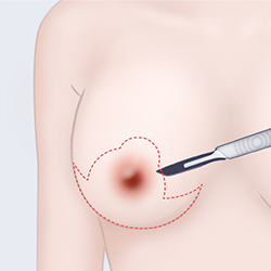 Removing only the epidermal layer after making incisions around the areola and under the breast