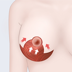 Correcting sagging mammary tissue and skin after excision and removal during breast surgery