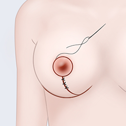 Suturing the surgical site while adjusting the size of the areola during breast surgery