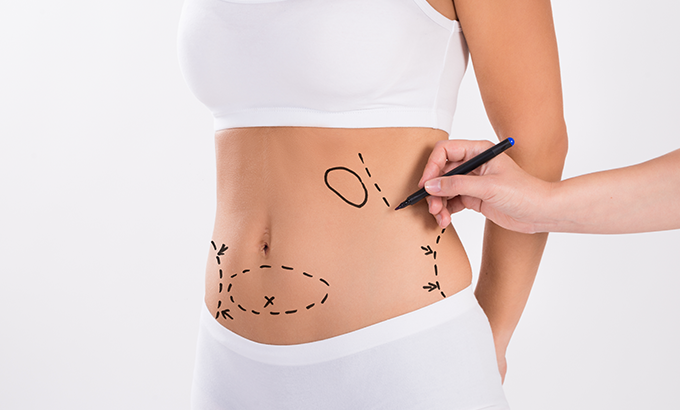 Tummy Tuck