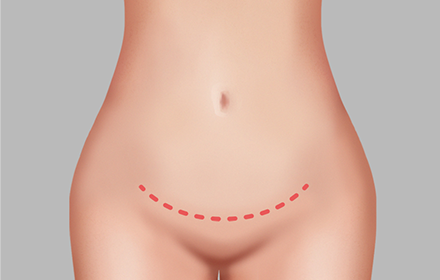 Above (or inside) the bikini line