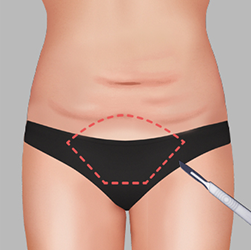 Making an incision inside the bikini line during body contouring surgery