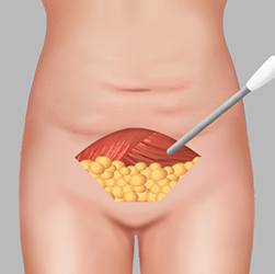 Lifting the upper abdominal tissue and suctioning excess fat to achieve the desired contour