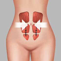 Gathering and tightening the rectus abdominis muscle during abdominal surgery