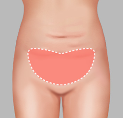 Small area on the lower abdomen