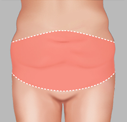 Wider area on the lower abdomen