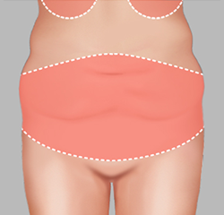 Sagging breast & Abdomen