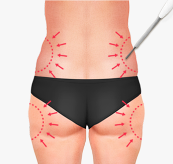 Marking and designing the treatment area on the skin prior to the procedure