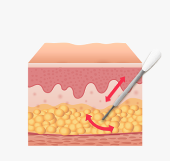Injecting lipolysis solution into the subcutaneous fat layer through a small 3 mm incision